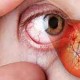 Diabetes eyes