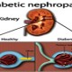 kolye va diabetes